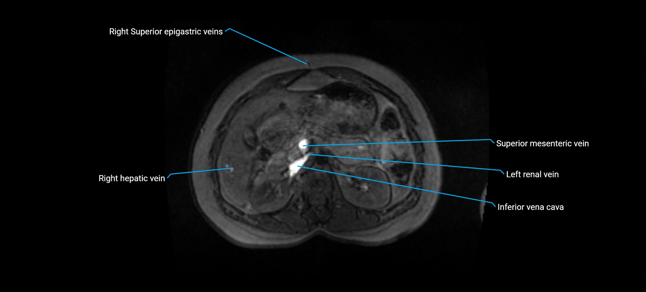 MRV abdomen pelvis & lower limb axial cross sectional anatomy labelled MRI image 58 (1).webp